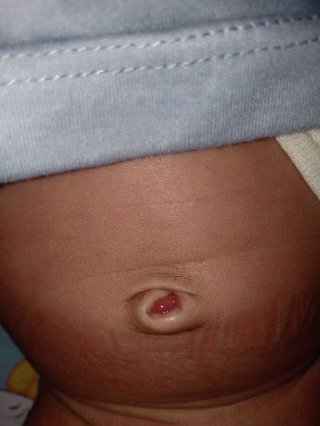 ganuloma umbilicalis
