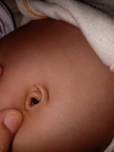 granuloma umbilical