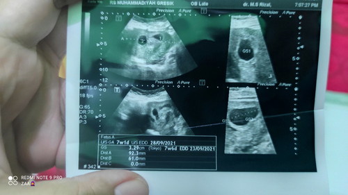 BO, sebaiknya tunggu atau kuret