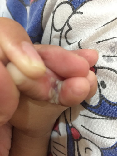 Sela sela jari kaki bayi seperti melepuh