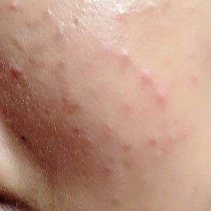 ปัญหา สิวๆ