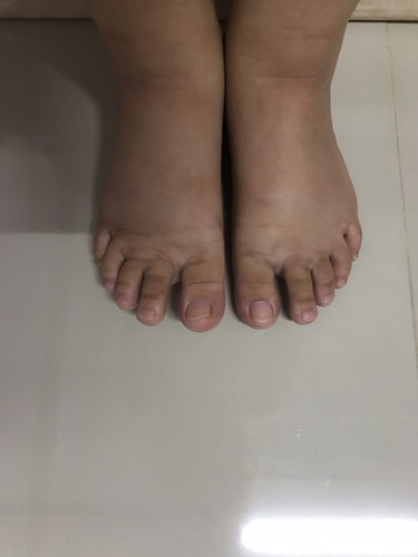 เท้าบวม