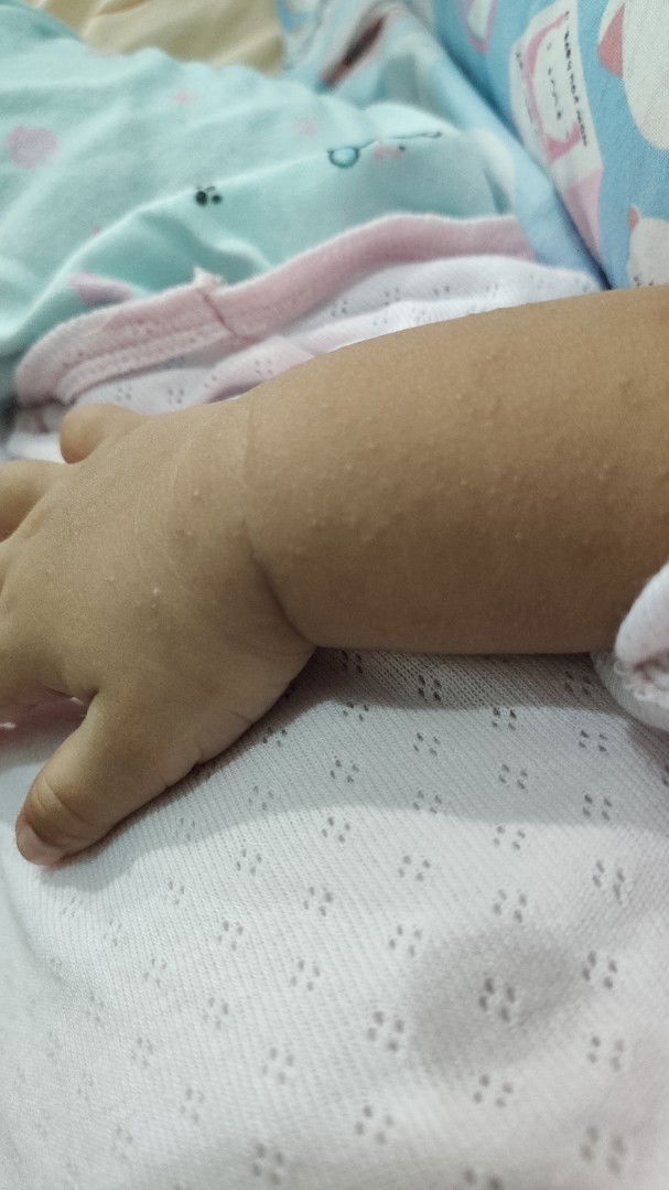 bruntusan seperti biang keringat