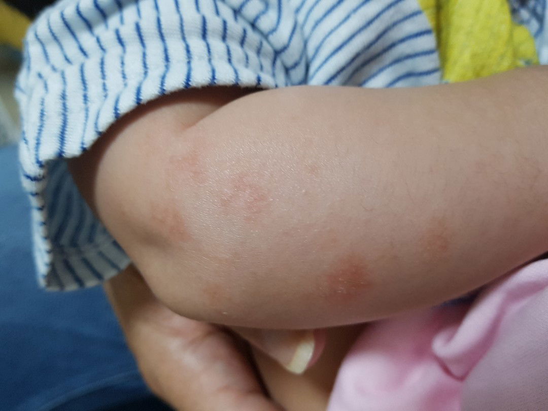 พอทราบอาการผื่นแบบนี้กันมั้ยคะคุณแม่