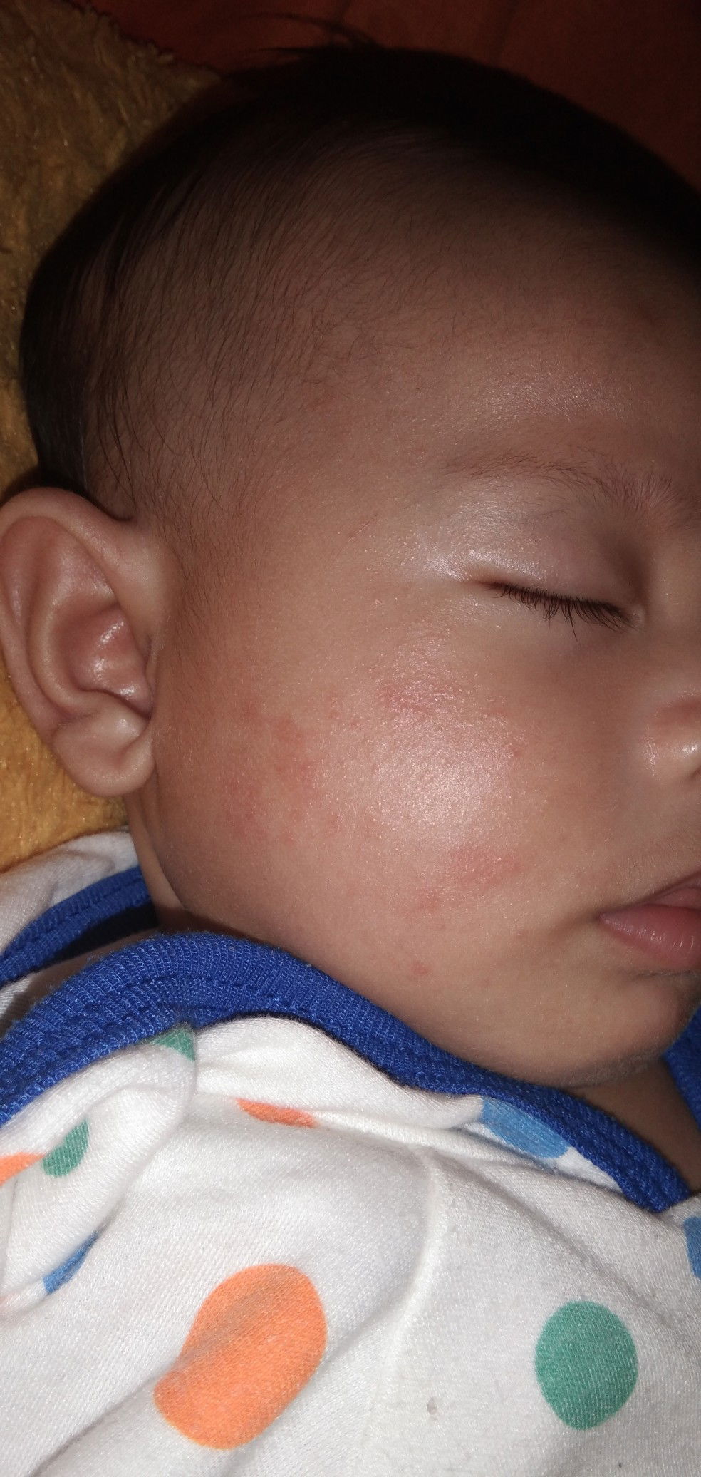 Pipi merah dan bruntusan