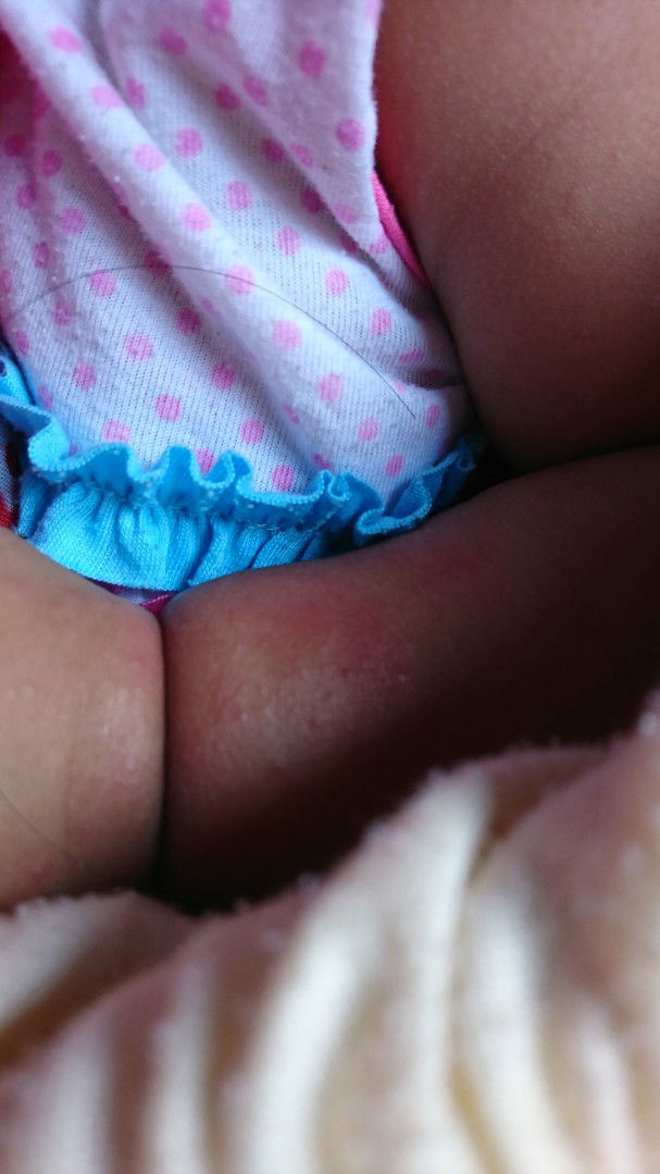 bintik merah d tangan