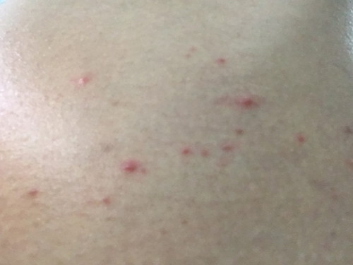 ขึ้นผื่นที่ท้อง