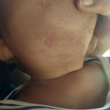 หัวน้องมีจ้ำๆแดงต่อมามีแผล