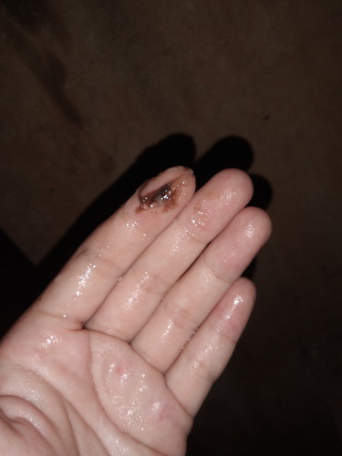 มูกเลือดหรือป่าว?