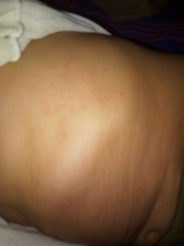 bintik" merah di area badan