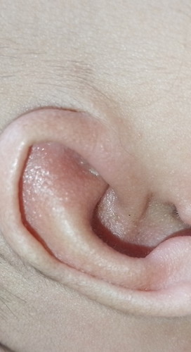 Iritasi setelah pake baby oil