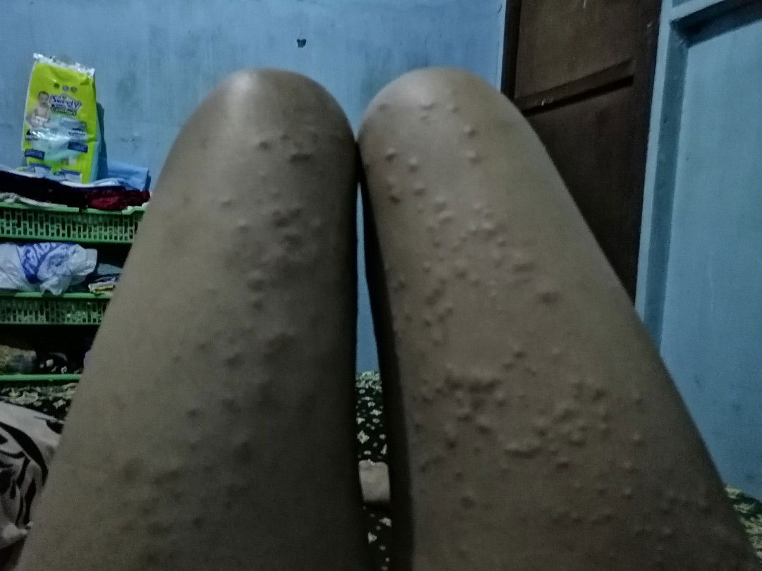 Kulit Bentol2 Pasca Lairan SC