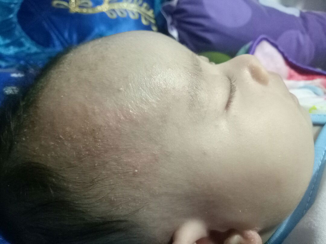 bun ada ngk kepala bayi bintil2 merah seperti ini.penyebab nya apa dan obatnya?