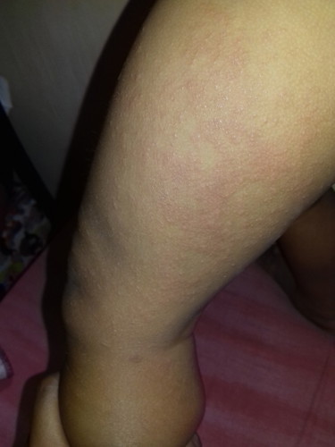 Skin rash
