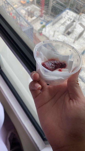 Bleeding 5 weeks sampai gugur