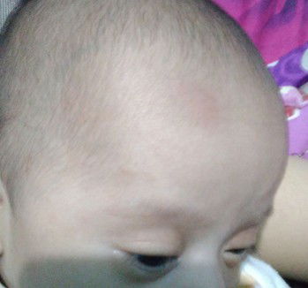 kepala bayi kepentok sikut