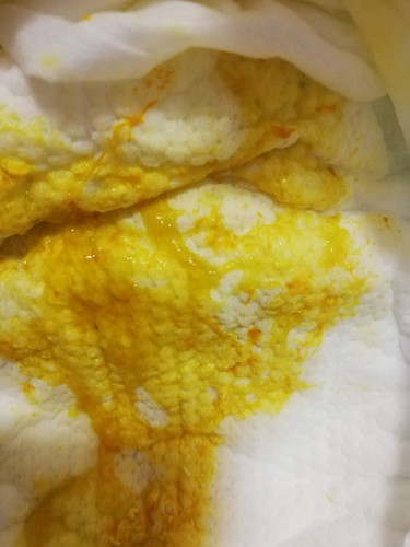 แบบนี้ใช่ถ่ายเป็นมูกเลือดมั้ยคะ มีรูปประกอบ