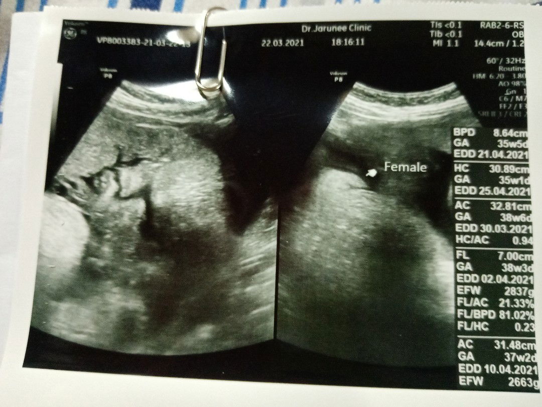 วันนี้ไปซาวมาคุณหมอบอกว่ารกพันคอลูกเราตกใจมากแต่หมอบอกว่าแค่รอบเดียวไม่เป็นไรเราควรทำอย่างไรดีค่ะ