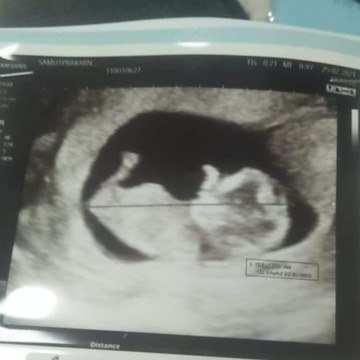 เด็ก 11 week ปกติจะเห็นชัดและตัวใหญ่แบบนี้มั้ยคะ มีแต่คนไม่เชื่อว่าน้อง 11 week คะ.