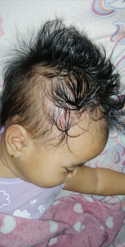 Cradle Cap