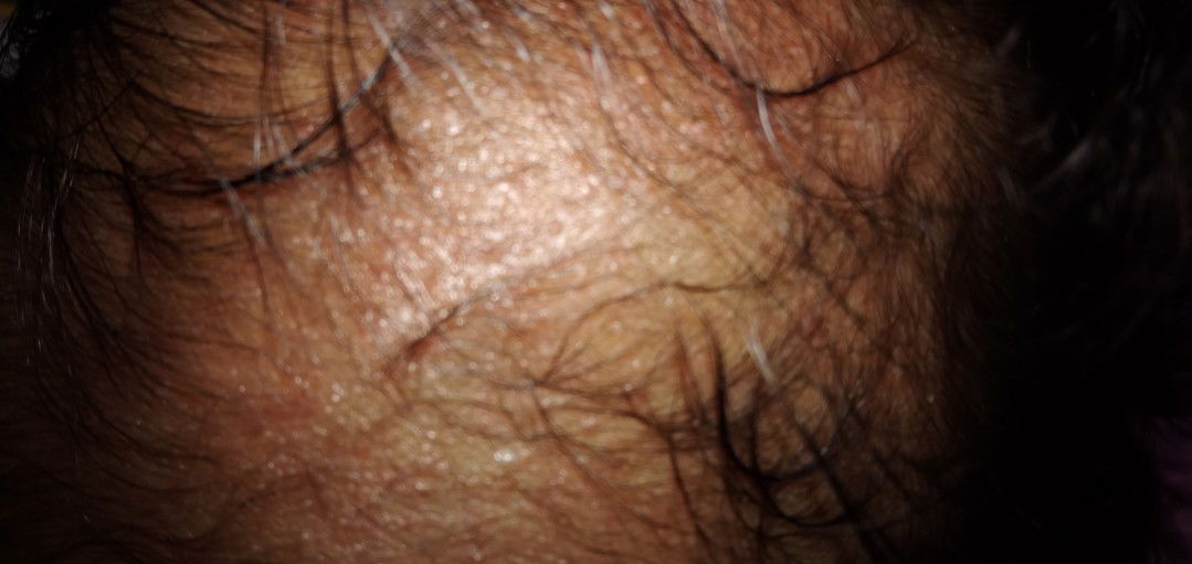 Kulit Kepala Berbintik