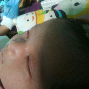 kulit bayi muncul brintisan