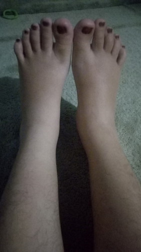 KAKI BENGKAK