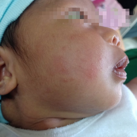 Baby Acne?