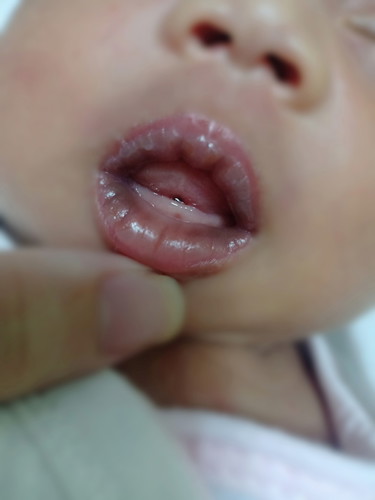 LO's lip is bluish. HELP!!!