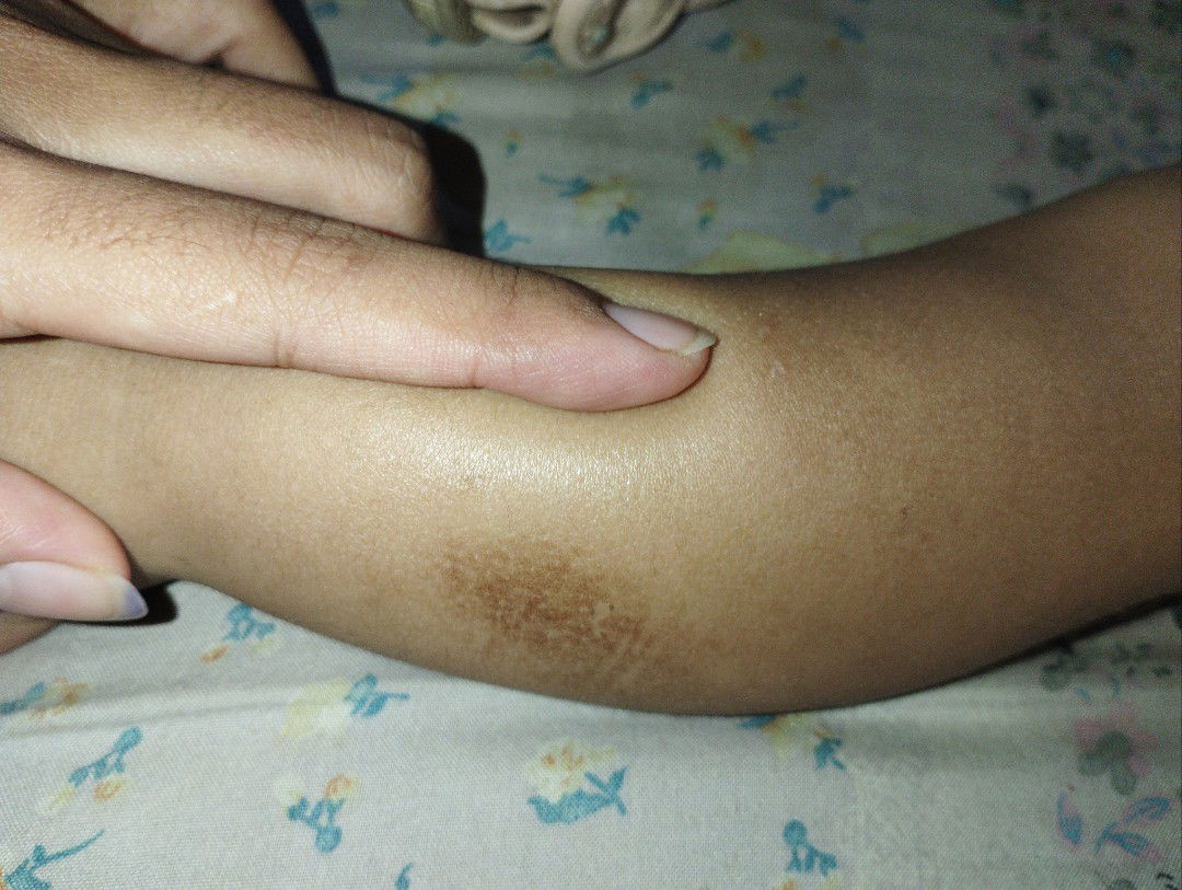 Kulit menggelap dan kering