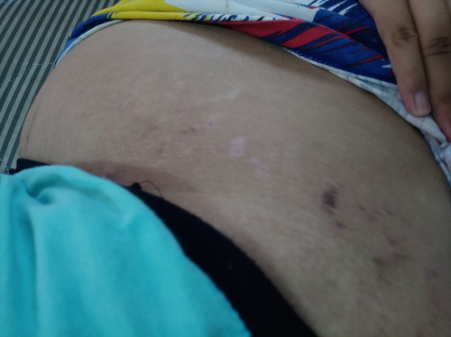 ทำไงคะให้ท้องไม่แตกเพิ่ม