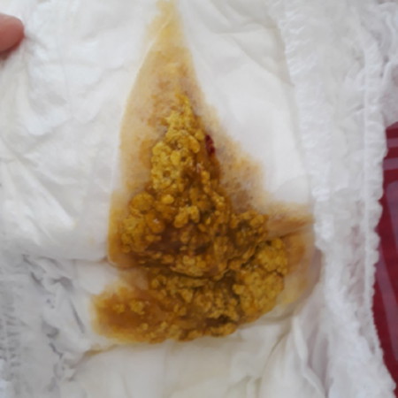 ท้องเสีย