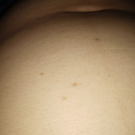 มีเม็ดๆขึ้นที่ท้อง