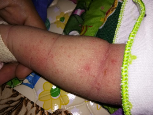 Obat bintik merah pada bayi