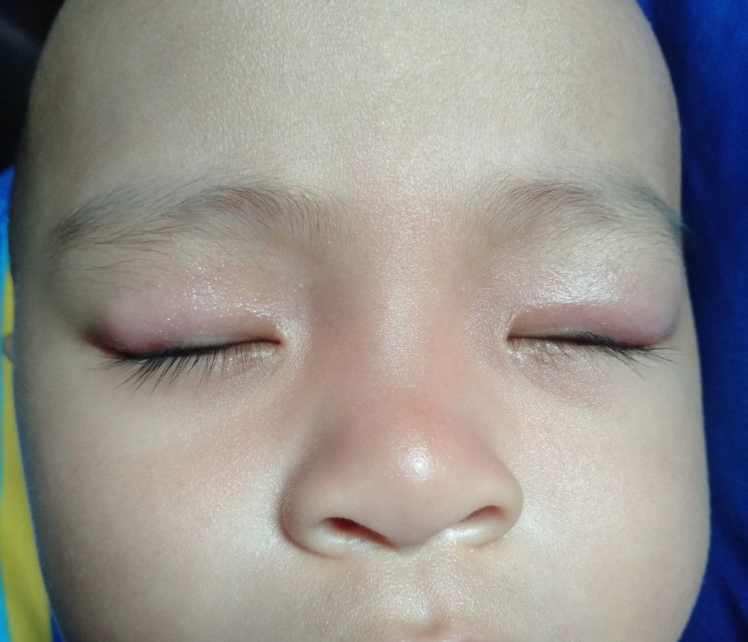 kelopak mata bengkak