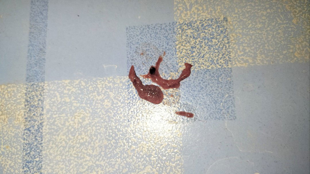 สอบถามหน่อยค่ะ 37+6w