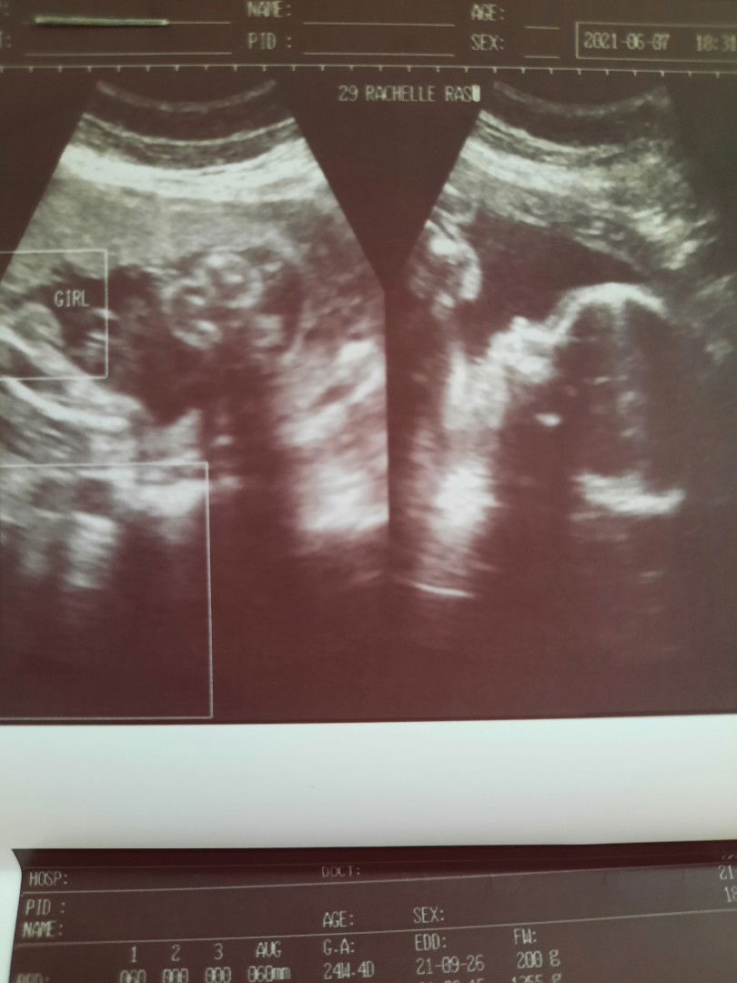 How accurate is the pelvic ultrasound at 25weeks?