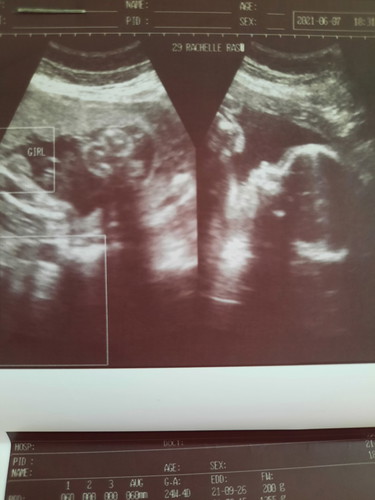 How accurate is the pelvic ultrasound at 25weeks?