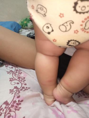insect bites