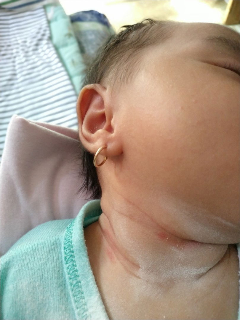 iritasi lipatan kulit