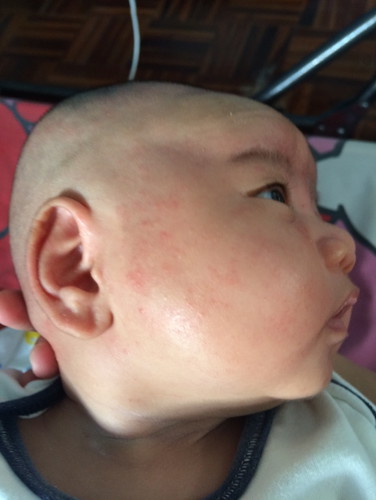 ลูกเป็นผื่นค่ะทำยังไงดี