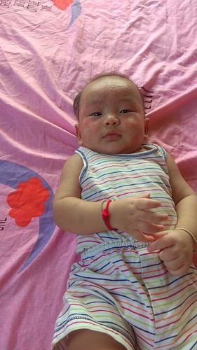 แบบนี้น้องแพ้นมไหมค่ะ น้องทานนมแม่ล้วนค่ะ แต่ผื่นเพิ่งขึ้นแดงค่ะตอน 4 เดือนค่ะ