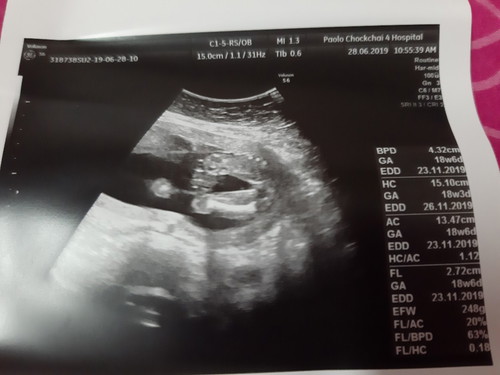 อัลตร้าซาว์นแล้ว 18w6d หมอบอกได้ลูกสาวจ้า80%