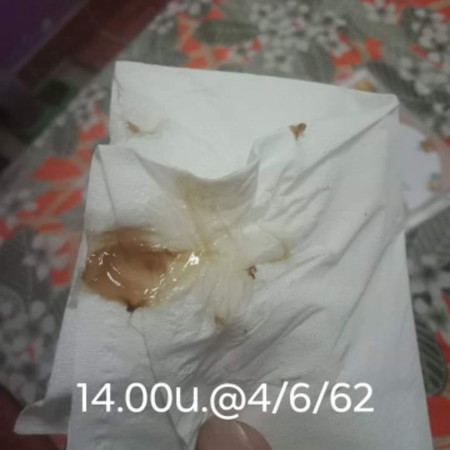 มูกเลือดออก วันนี้เป็นวันที่2แล้ว