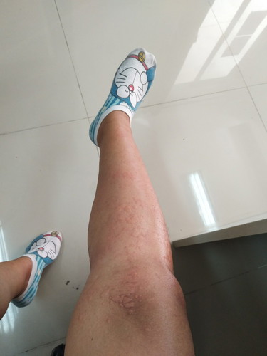 ผื่นขึ้นขาตอนท้อง