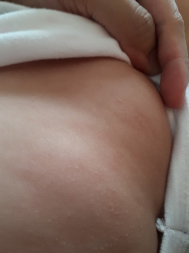 butlig sa skin ni baby