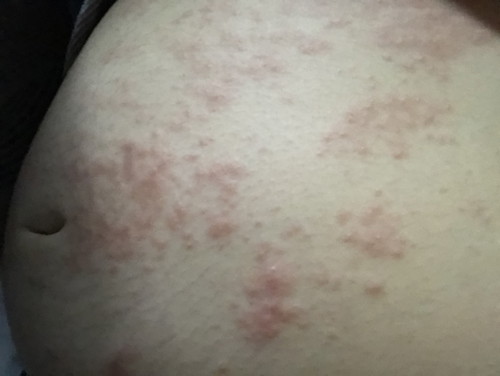 ผื่นตั้งครรภ์ก็มาค่ะ