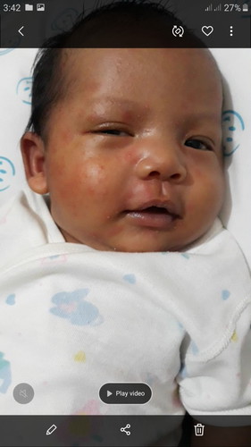 First Time Mom on Baby Skin Problem