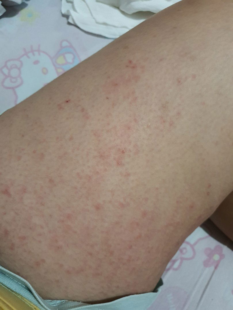 pangangati pagkatapos manganak