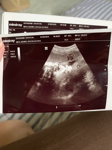 ใจหายแว๊บ นอกจากอยากรู้เพศลูก แนะนำให้ดูเรื่องปากแหว่งเพดานโหว่ด้วยนะคะ